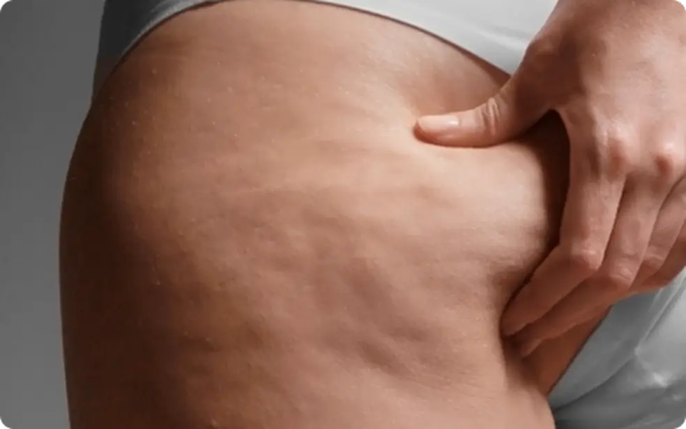 Борьба с целлюлитом