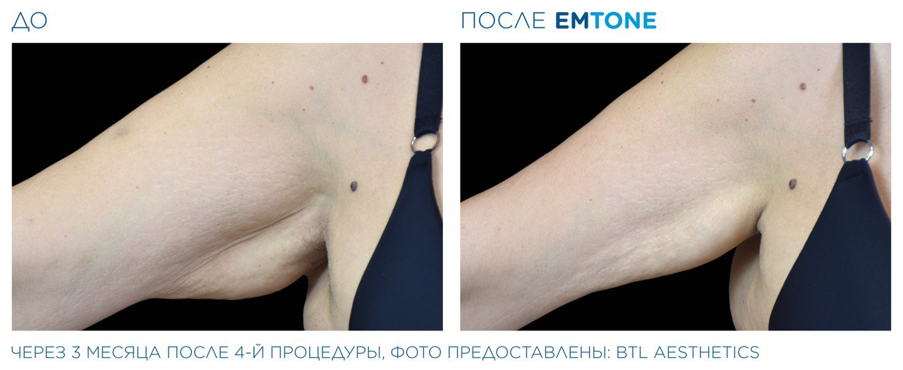 Лечение дряблости кожи