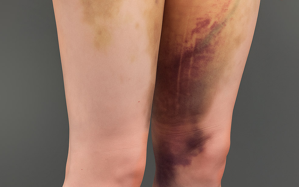 Подготовка и восстановление после липосакции