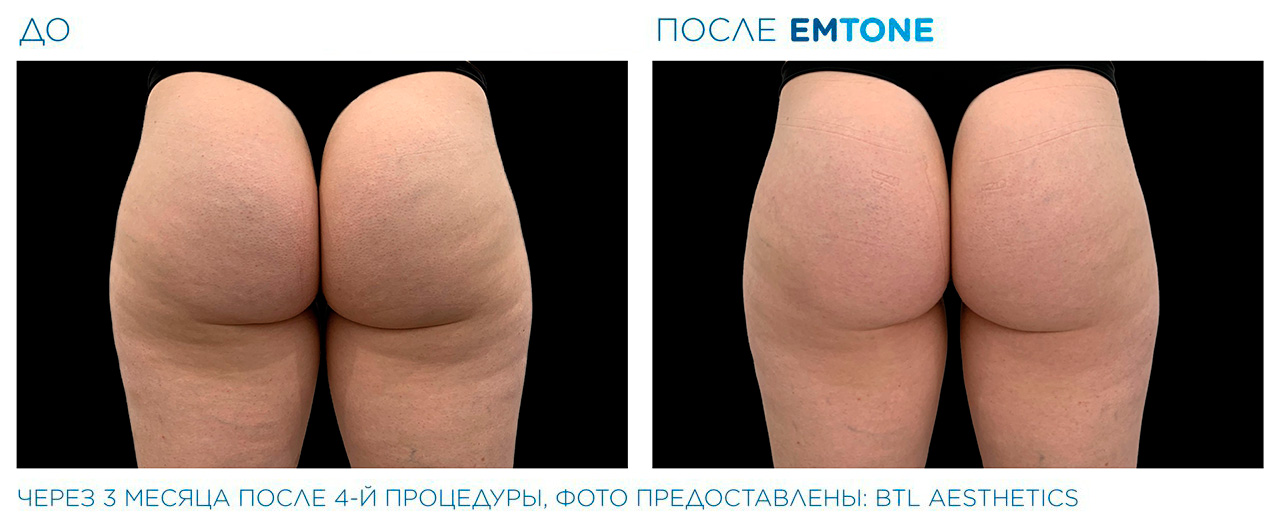 Моделирование фигуры и лечение целлюлита