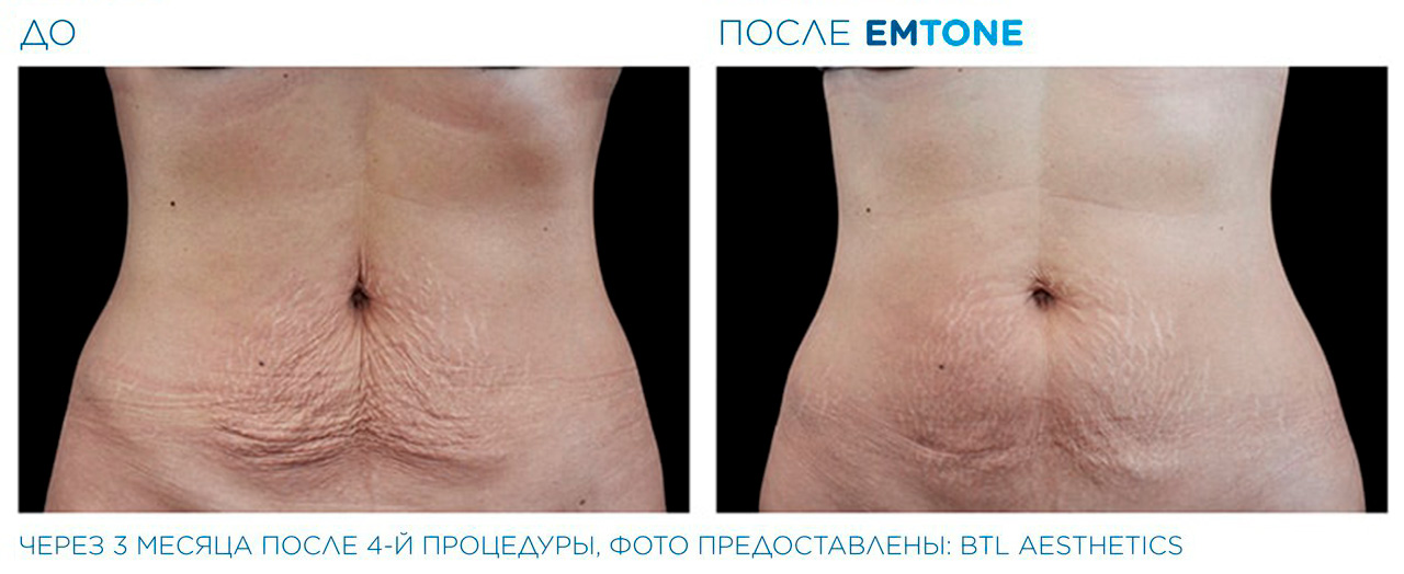 Улучшение тонуса кожи