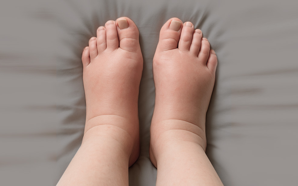 Уменьшение отёков и улучшение микроциркуляции